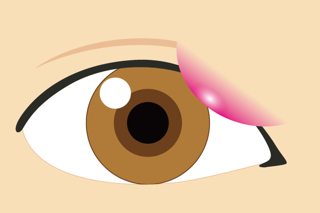 麦粒腫（ばくりゅうしゅ）