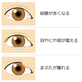 流行性結膜炎(はやり目)