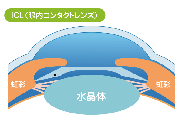 ICL視力矯正手術について